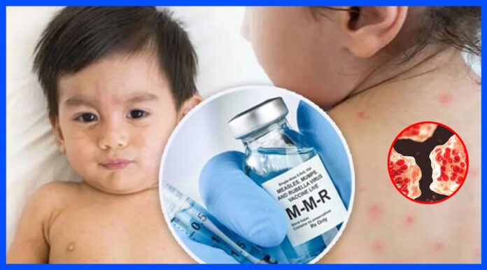 হামের টিকাদান কর্মসূচি নারায়ণগঞ্জ ও স্বাস্থ্য অধিদপ্তরের বিশেষ উদ্যোগ